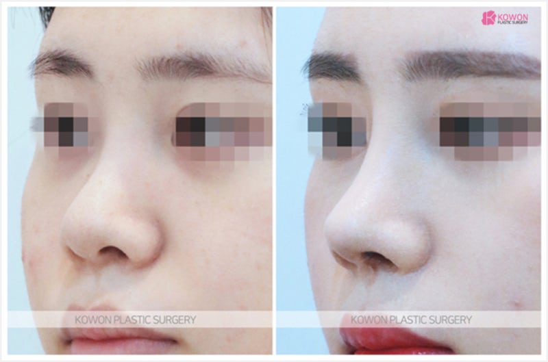 코필러코수술 후기 날렵한코 성형 방법 사진 3