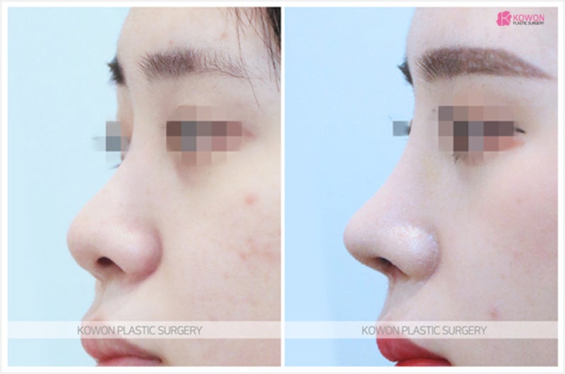 코필러코수술 후기 날렵한코 성형 방법 사진 6
