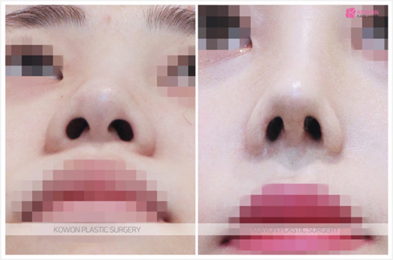 코필러코수술 후기 날렵한코 성형 방법 사진 5