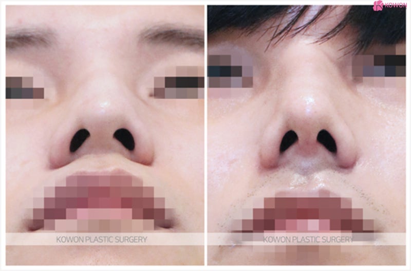 신논현코성형외과 남자 매부리코수술후기 사진 6