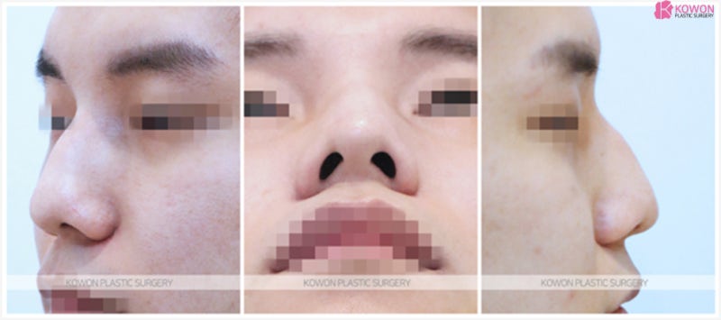 신논현코성형외과 남자 매부리코수술후기 사진 2