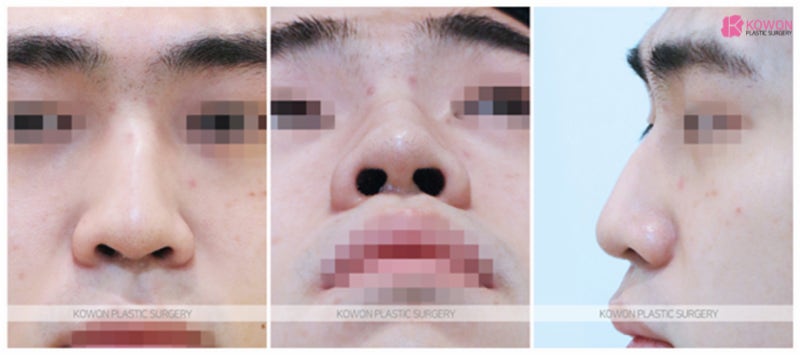 코끝연골묶기후기 코휘어짐 수술로 바뀐 이미지 사진 2