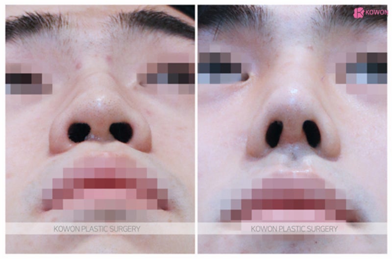 코끝연골묶기후기 코휘어짐 수술로 바뀐 이미지 사진 8