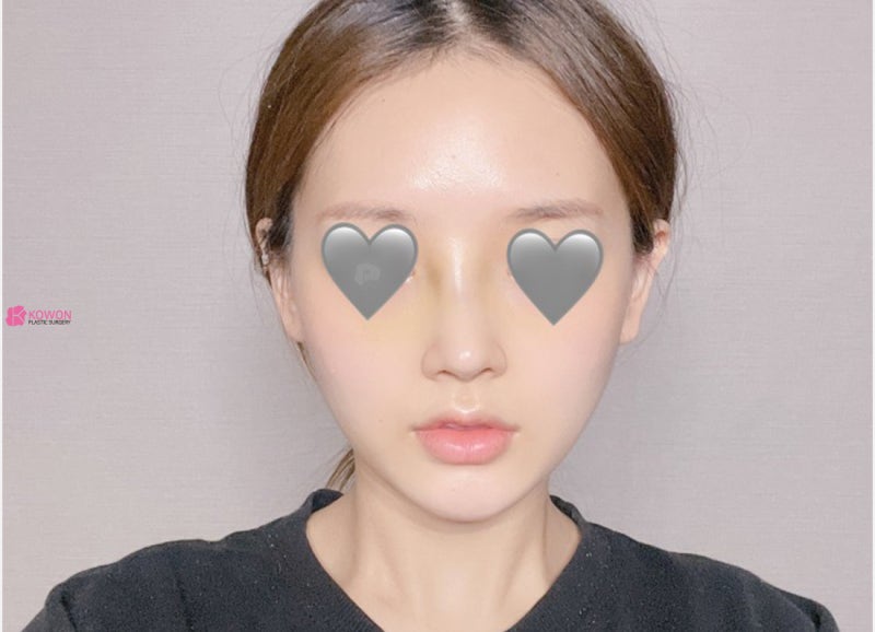 화살코관상 느낌 세련된코 수술로 이미지 개선 후기 사진 5