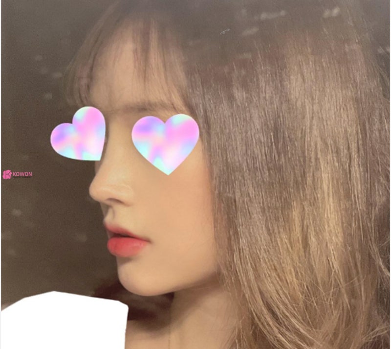 화살코관상 느낌 세련된코 수술로 이미지 개선 후기 사진 6