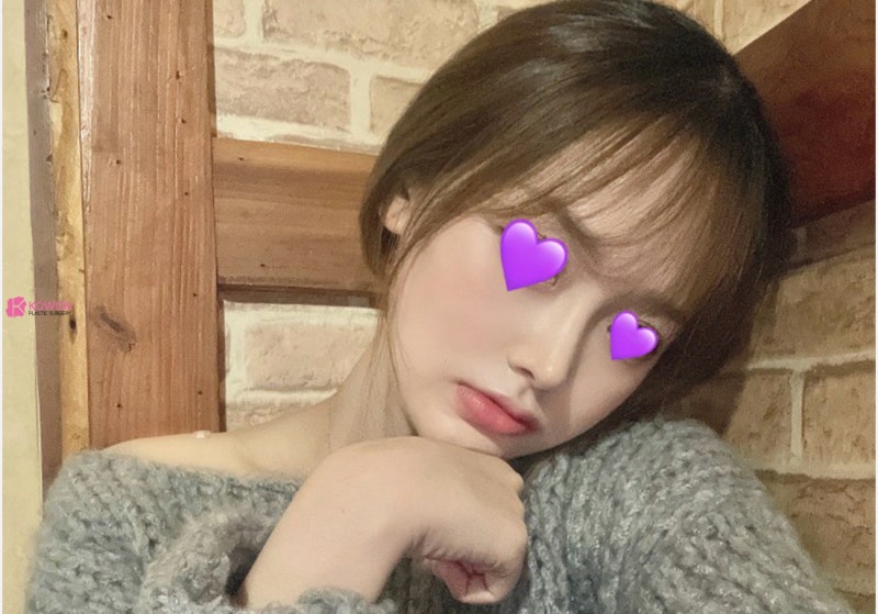 화살코관상 느낌 세련된코 수술로 이미지 개선 후기 사진 8