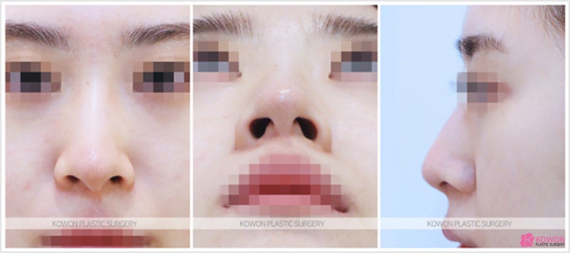 콧대휨 수술 코퍼짐 성형 성공적인 사례 사진 2
