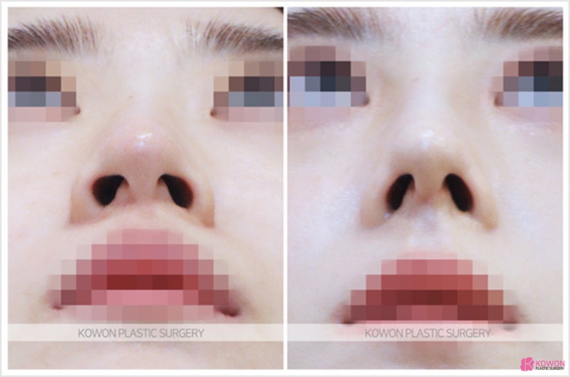 콧대휨 수술 코퍼짐 성형 성공적인 사례 사진 6