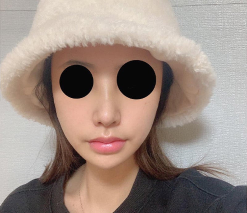 코성형유명한곳 비염도 개선한 비중격코수술후기 사진 10