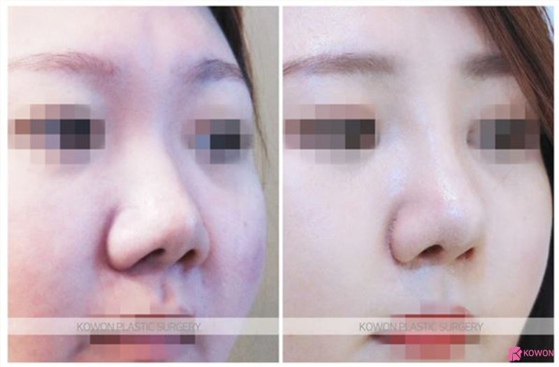 서울강남성형외과 돼지코 수술로 여성스러운코 되기 사진 4
