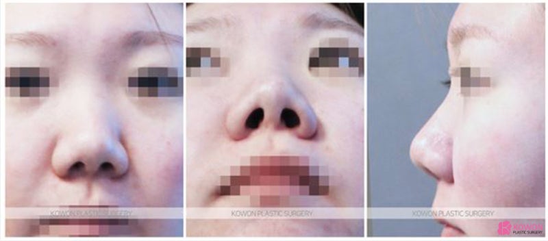 서울강남성형외과 돼지코 수술로 여성스러운코 되기