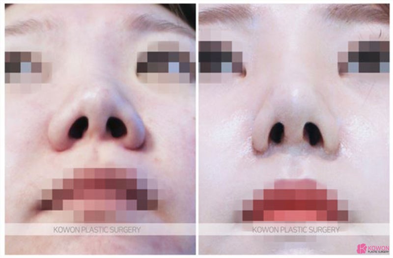 서울강남성형외과 돼지코 수술로 여성스러운코 되기 사진 5