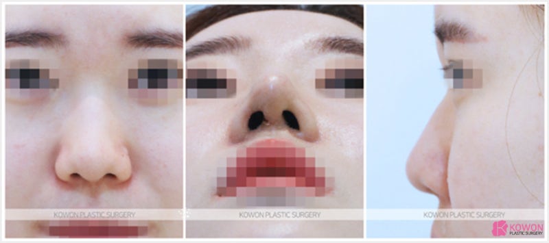 신사코성형 낮은미간 개선과 높아진 콧대 후기 사진 3