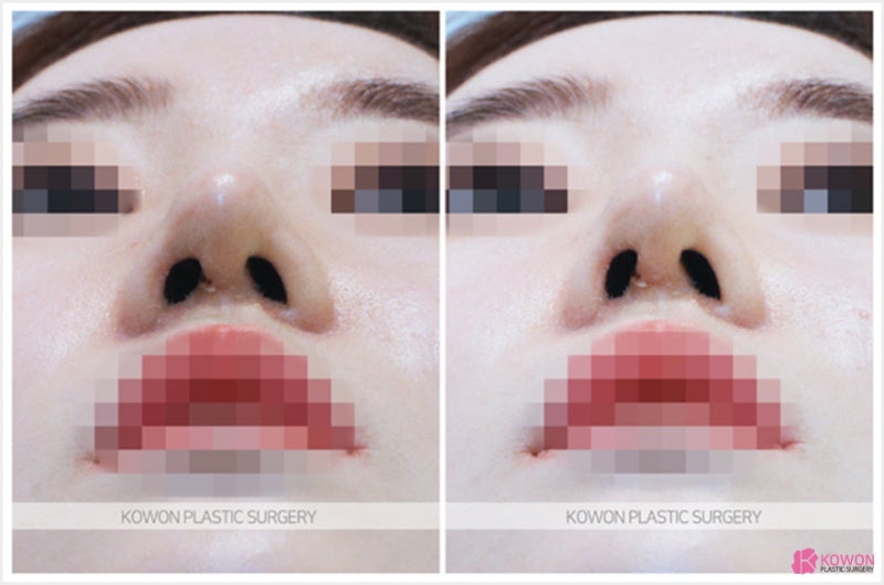 신사코성형 낮은미간 개선과 높아진 콧대 후기 사진 7