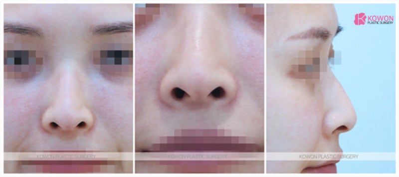 압구정동성형외과 퍼진 콧구멍은 코끝높이기 수술