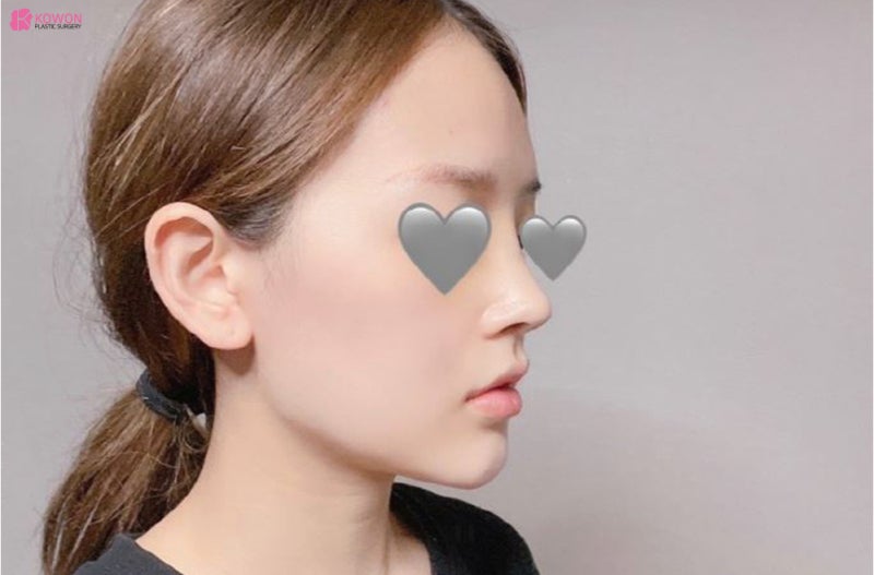 신사코수술 전후 사진으로 보는 필러후코수술 여부 사진 4