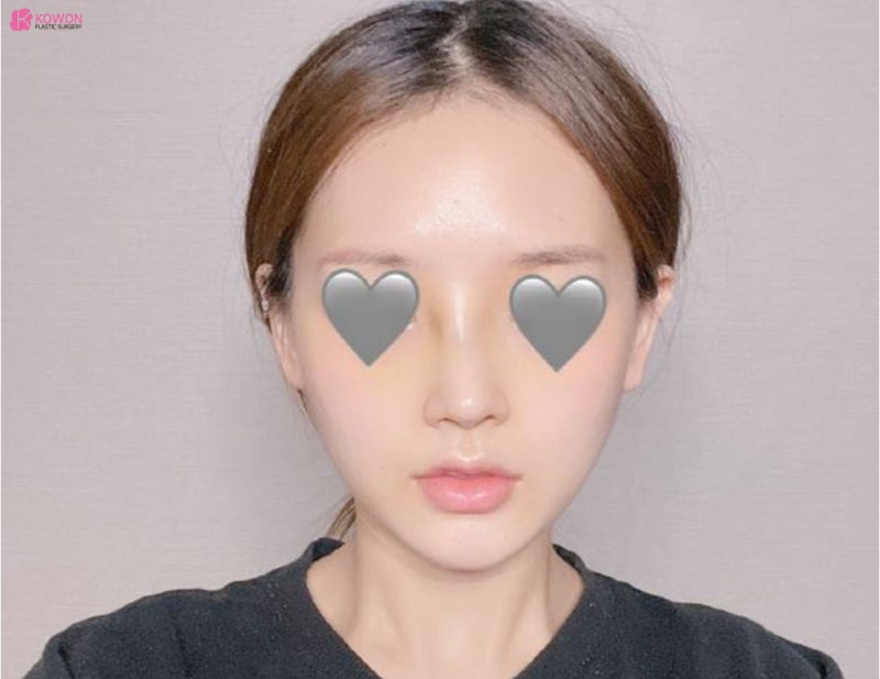 신사코수술 전후 사진으로 보는 필러후코수술 여부 사진 6
