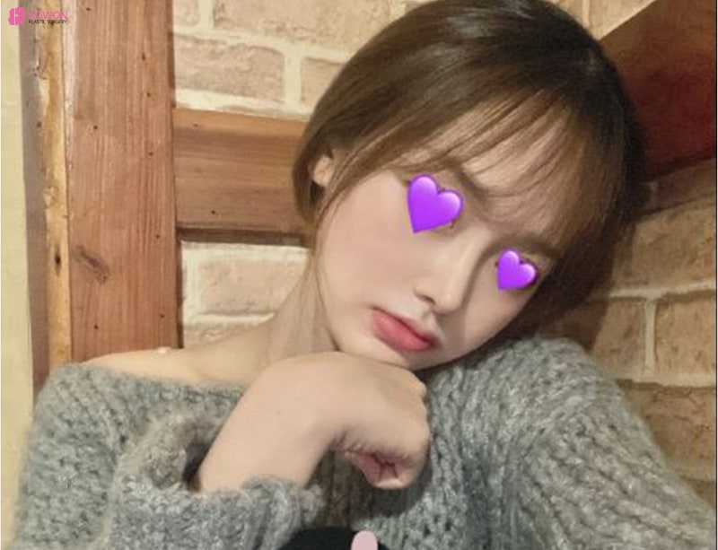 신사코수술 전후 사진으로 보는 필러후코수술 여부 사진 9