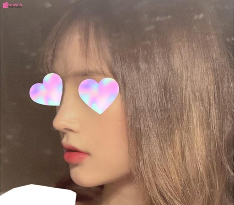신사코수술 전후 사진으로 보는 필러후코수술 여부 사진 7
