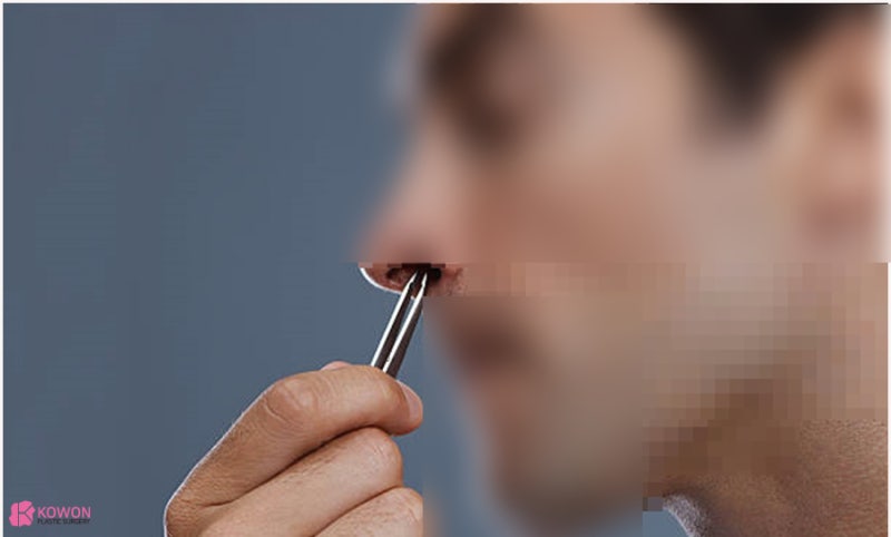 코털 뽑으면 셀프 제모 정리 관리법 위험성 및 문제 사진 10