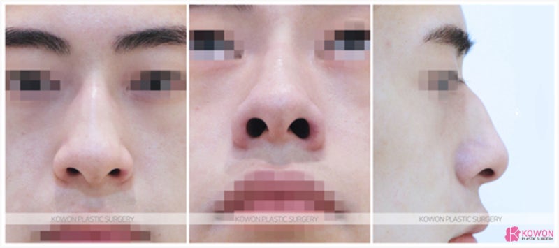 코만하는성형외과 매부리코 무보형물코성형