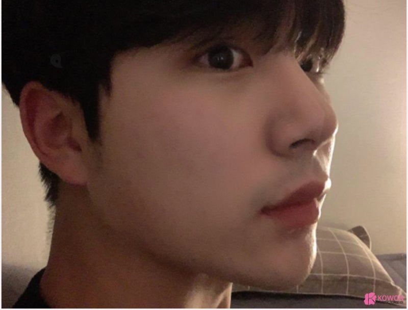 코재성형 잘하는 곳 남자직선코 수술 후기 사진 11