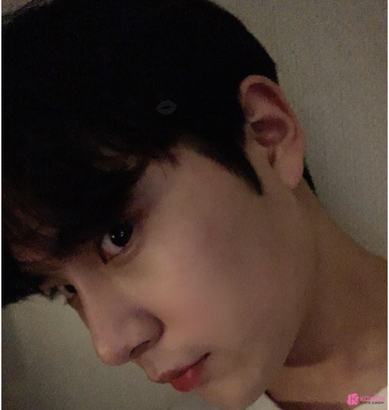 코재성형 잘하는 곳 남자직선코 수술 후기 사진 8
