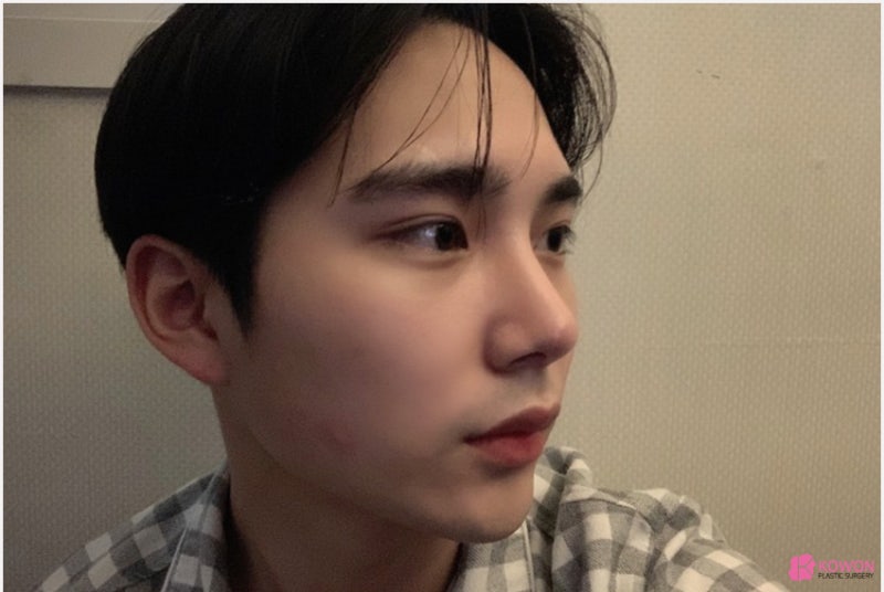 코재성형 잘하는 곳 남자직선코 수술 후기 사진 5