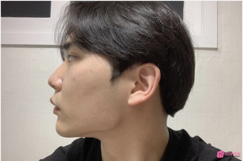코재성형 잘하는 곳 남자직선코 수술 후기 사진 3