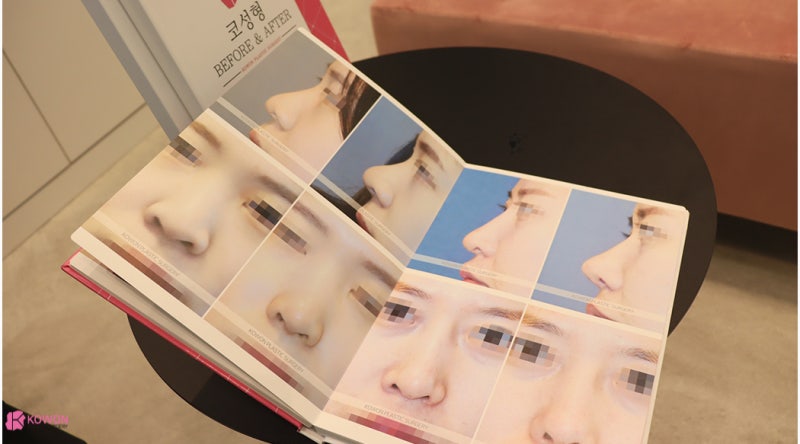 신사역코성형 콧대 높이기로 진행한 버선코수술