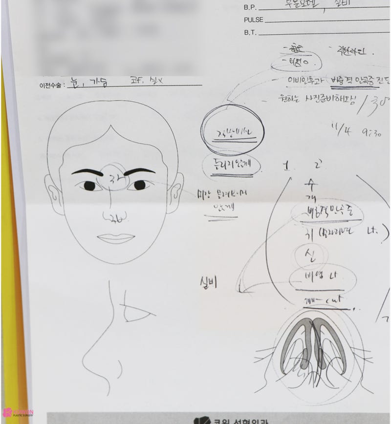 신사역코성형 콧대 높이기로 진행한 버선코수술 사진 3