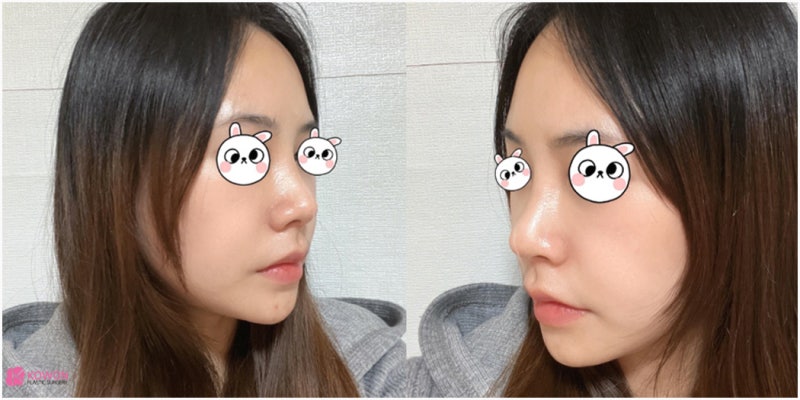 신사역코성형 콧대 높이기로 진행한 버선코수술 사진 14