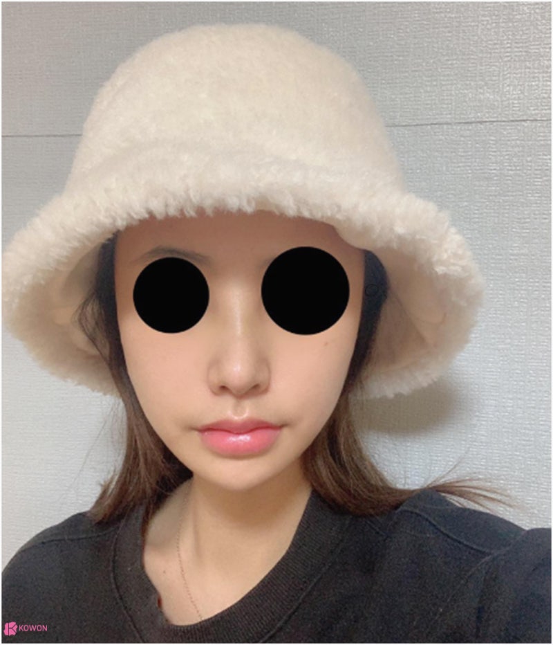 신사역코성형 콧대 높이기로 진행한 버선코수술 사진 11