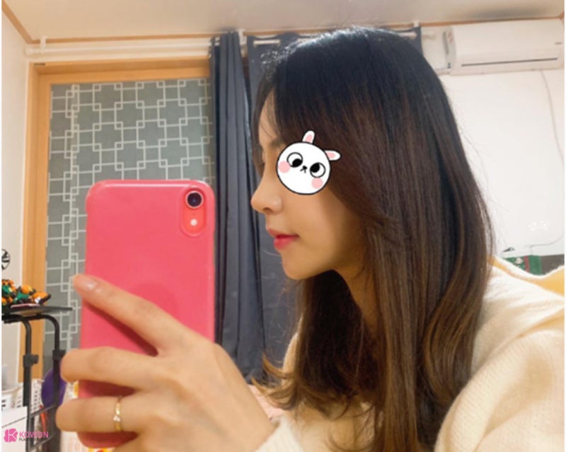 신사역코성형 콧대 높이기로 진행한 버선코수술 사진 6