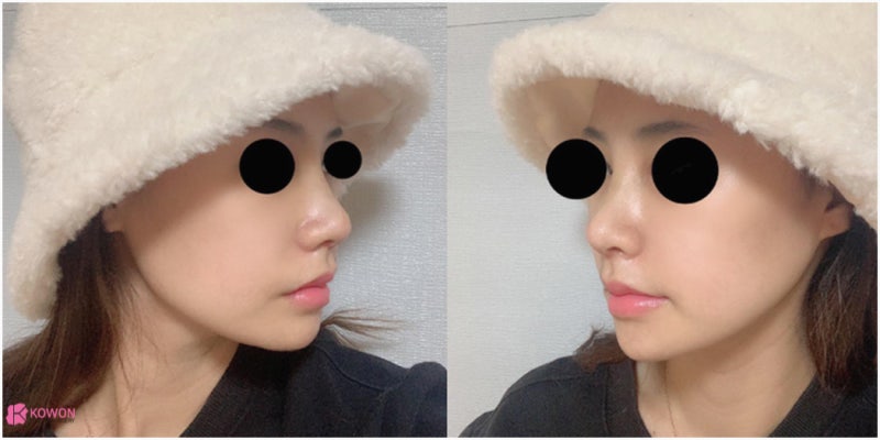 신사역코성형 콧대 높이기로 진행한 버선코수술 사진 9