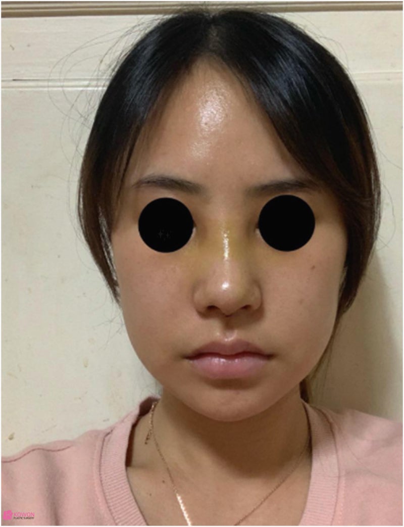 신사역코성형 콧대 높이기로 진행한 버선코수술 사진 8