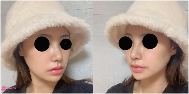 신사역코성형 콧대 높이기로 진행한 버선코수술 사진 10