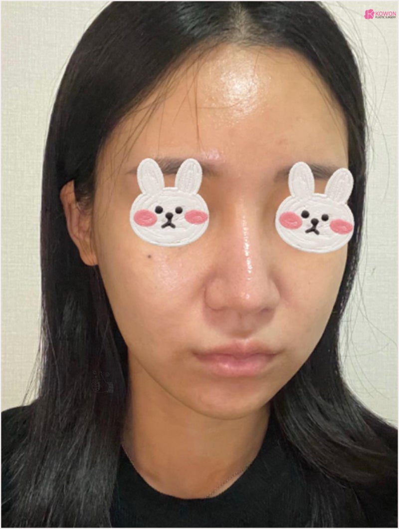 강남코수술 아낙필라시스 대비로 부작용 걱정 없는 곳 사진 3