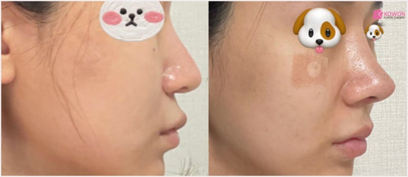 강남코수술 아낙필라시스 대비로 부작용 걱정 없는 곳 사진 10