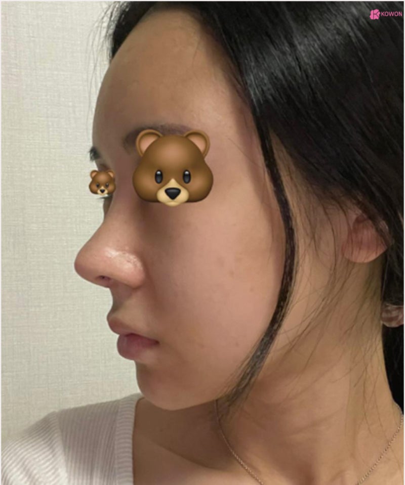 강남코수술 아낙필라시스 대비로 부작용 걱정 없는 곳 사진 6