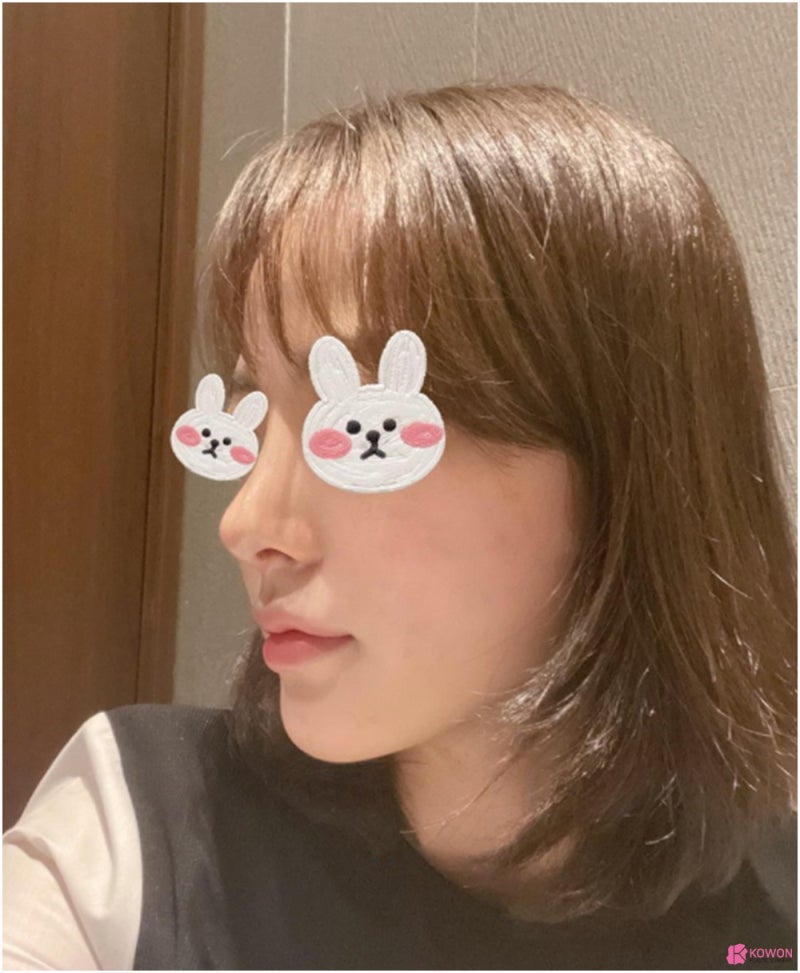 코성형외과추천 코필러후수술 3개월 차 비교 사진 사진 6