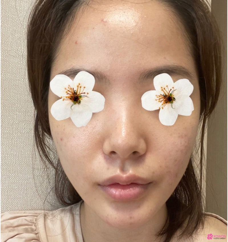 코성형외과추천 코필러후수술 3개월 차 비교 사진 사진 3