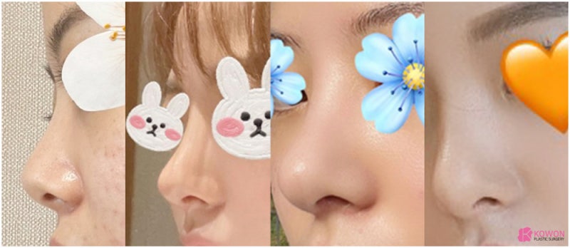 코성형외과추천 코필러후수술 3개월 차 비교 사진