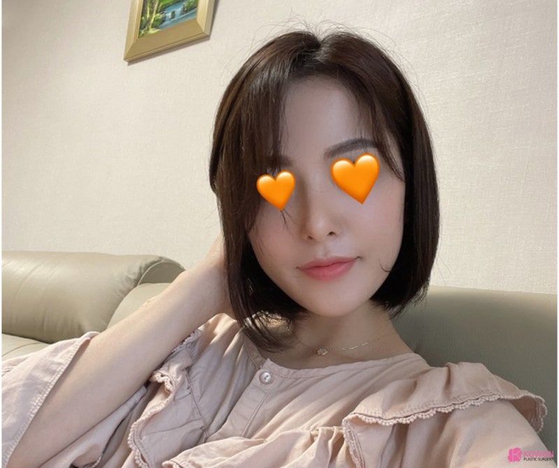 코성형외과추천 코필러후수술 3개월 차 비교 사진 사진 12