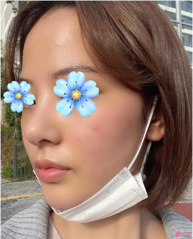 코성형외과추천 코필러후수술 3개월 차 비교 사진 사진 9