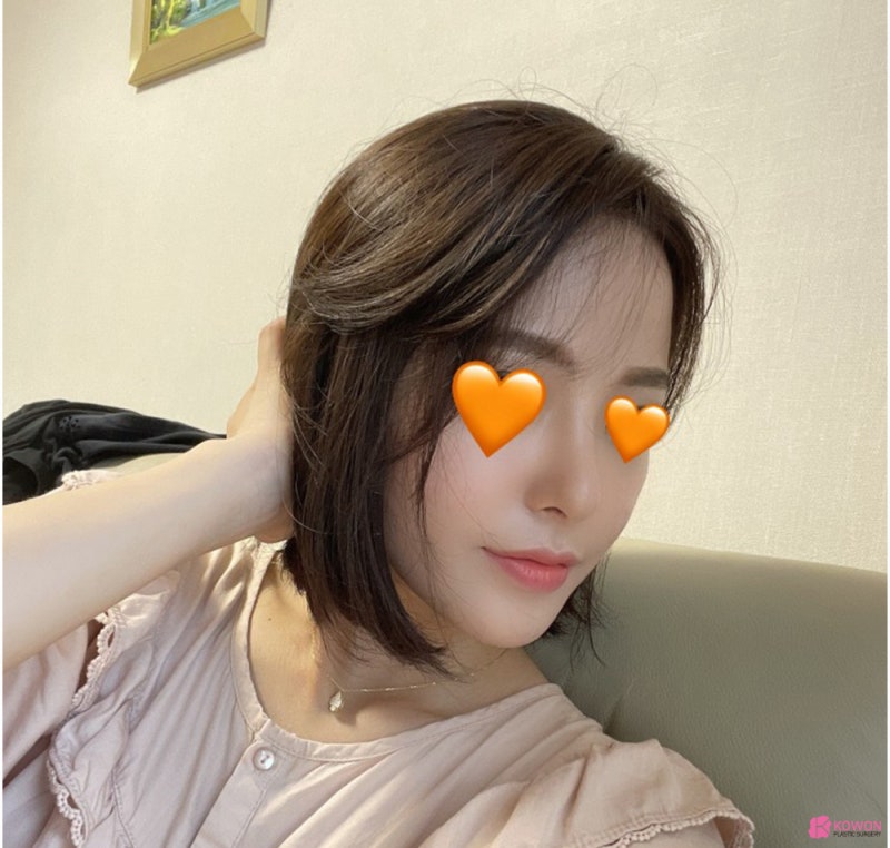 코성형외과추천 코필러후수술 3개월 차 비교 사진 사진 11