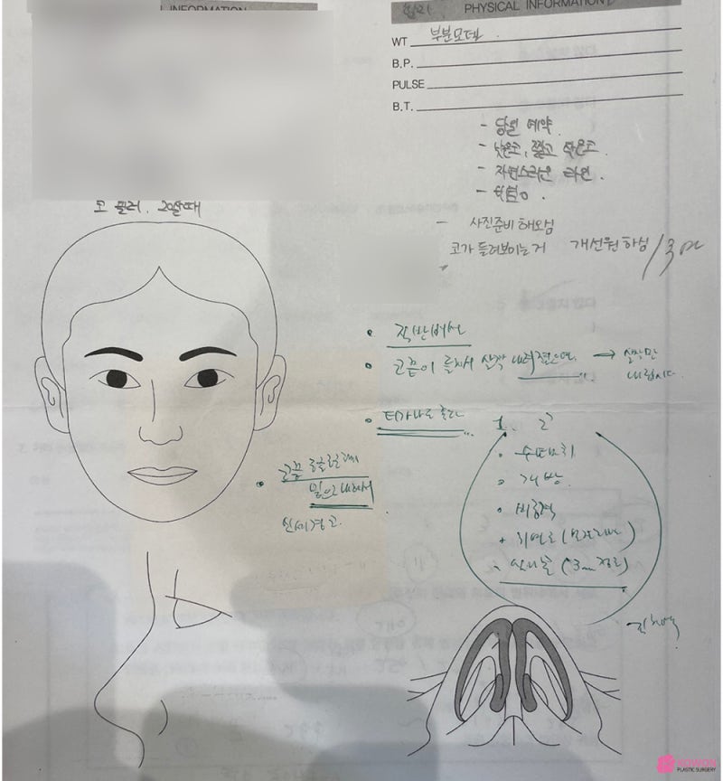 코성형외과추천 코필러후수술 3개월 차 비교 사진