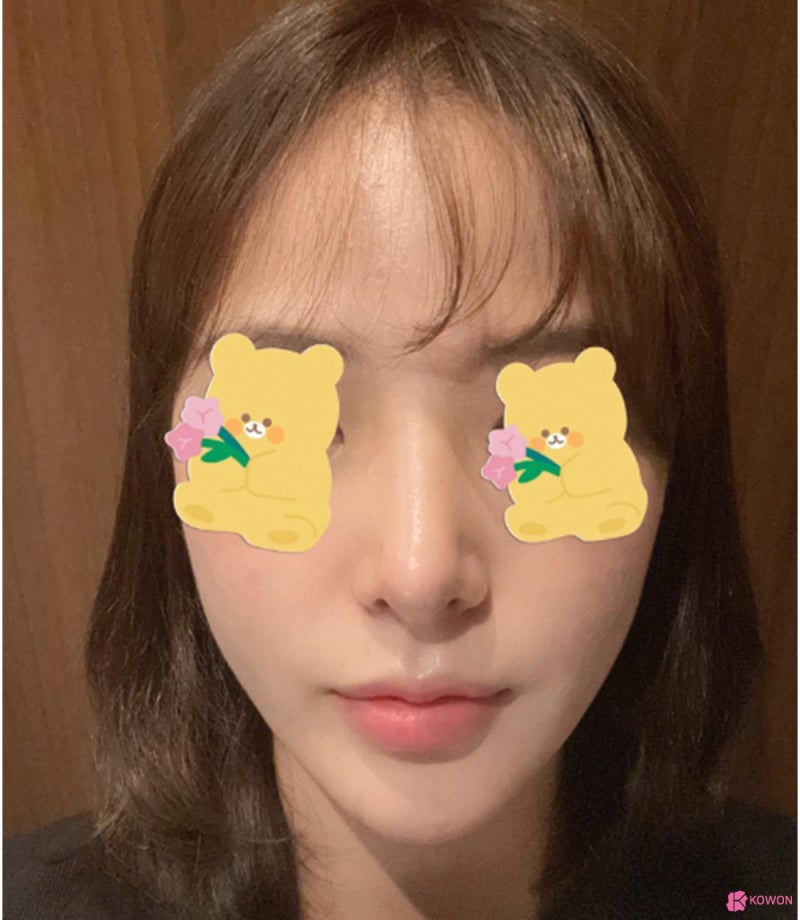 코성형외과추천 코필러후수술 3개월 차 비교 사진 사진 7