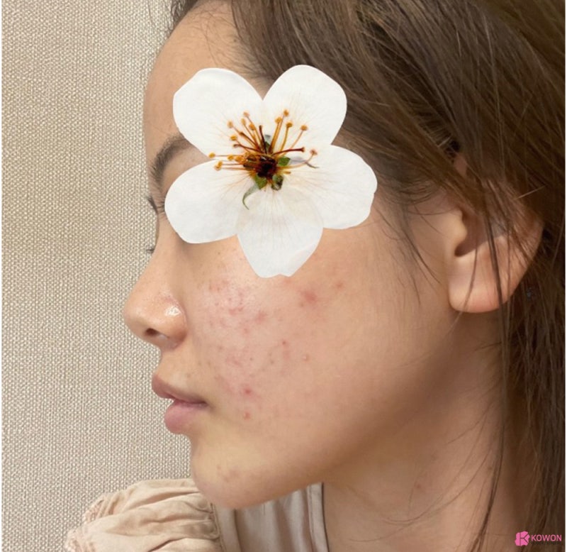 코성형외과추천 코필러후수술 3개월 차 비교 사진 사진 2