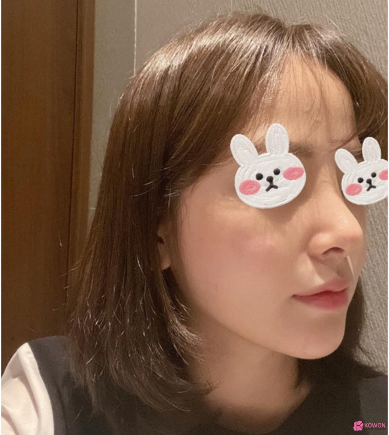 코성형외과추천 코필러후수술 3개월 차 비교 사진 사진 5